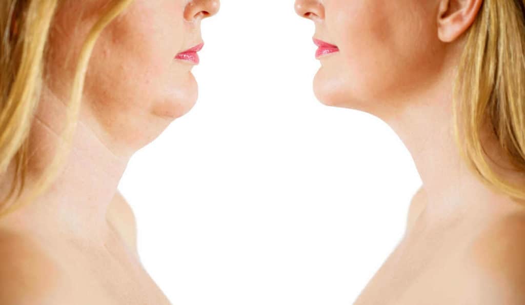 Double Chin treatment Greater London (Lambeth) before and after results