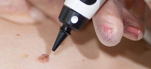 After Skin Tag Removal Greater London (Lambeth)