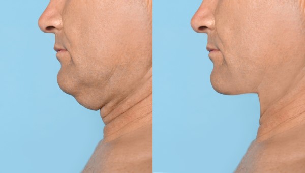 Which Non-Surgical Treatments Work Best for Jowls and Loose Skin Greater London (Lambeth)?