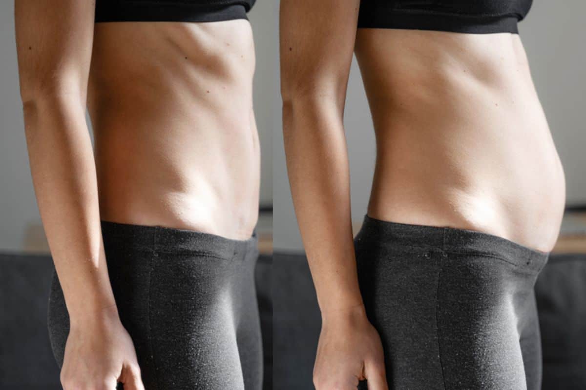 How long does diastasis recti take to improve Greater London (Lambeth)?