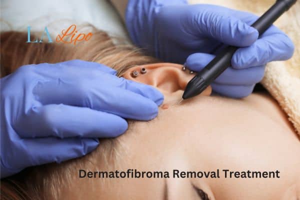Dermatofibroma Removal Treatment Greater London (Lambeth)