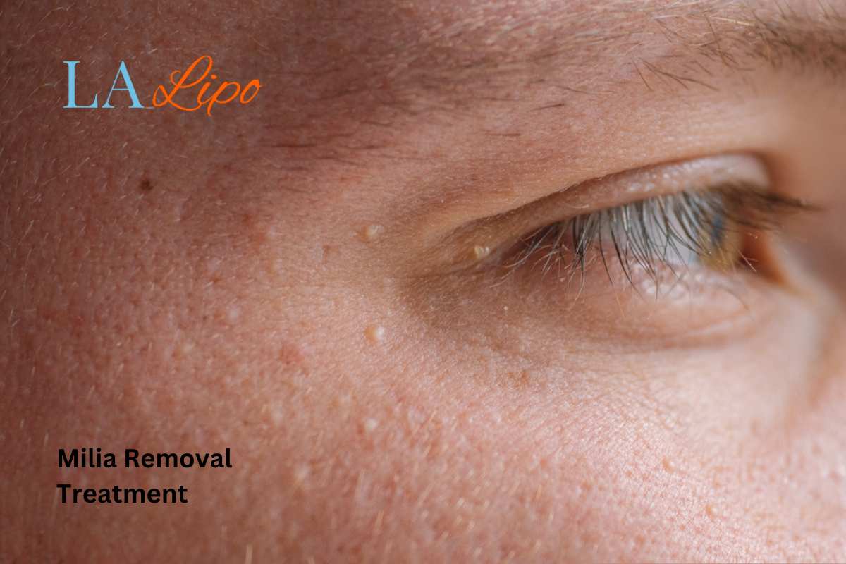 Cryopen Milia Removal: Is It the Easiest and Safest Option Greater London (Lambeth)?