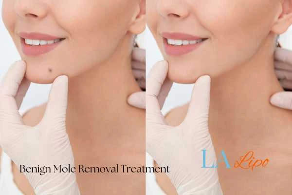 woman's before and after mole removal Greater London (Lambeth) results