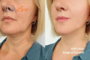 hi-fu for wrinkles Greater London (Lambeth) before and after results