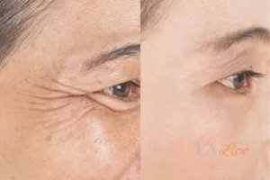 Before and after results of woman - HI-fu wrinkles reduction treatment Greater London (Lambeth)