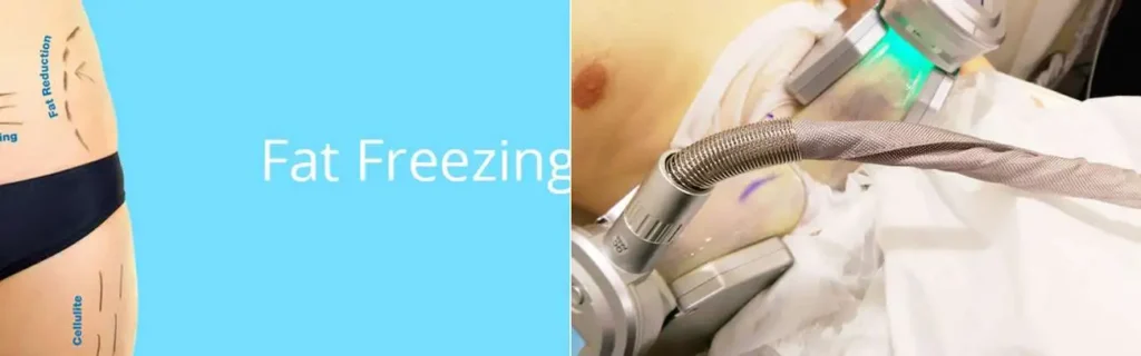 Fat freezing Greater London (Lambeth) on multiple areas of the body