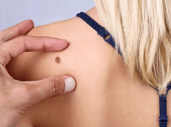 woman having mole removal Greater London (Lambeth) consultation before treatment.