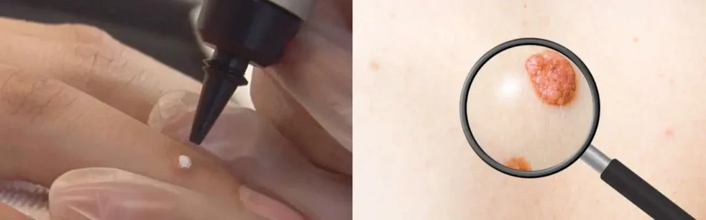 Cryopen for mole removal Greater London (Lambeth) - speak to our team today!