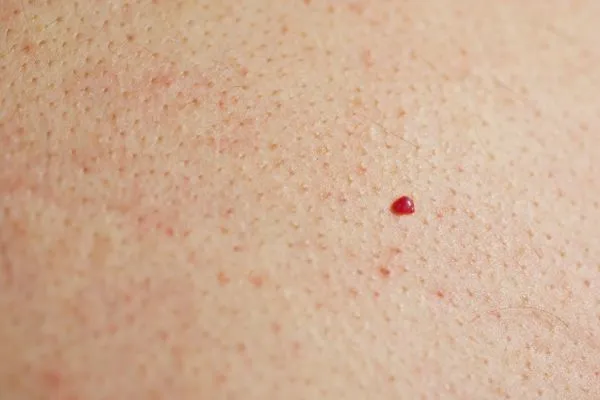 close up of a cherry angioma Greater London (Lambeth)