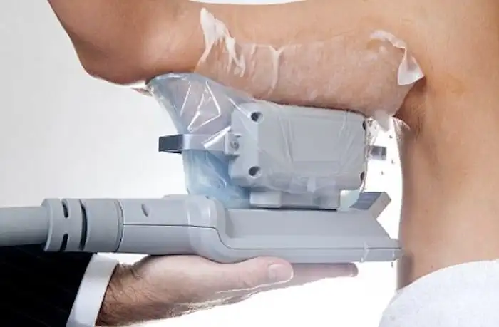 Picture of fat freezing Greater London (Lambeth) on the upper arms.