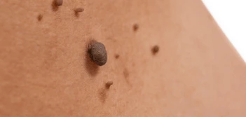 image of a skin tag Greater London (Lambeth)