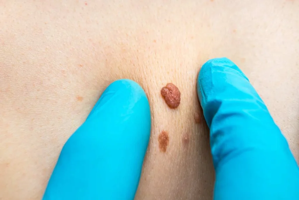 Consultant examining a skin tag Greater London (Lambeth)