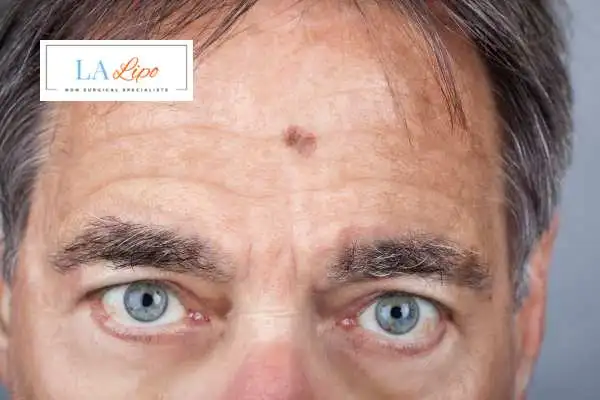 Solar Lentigo Removal Greater London (Lambeth) image of man with mark on his forehead