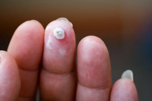 wart on person finger - cryotherapy to treat from LA LIPO Greater London (Lambeth)