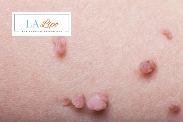 Does cryopen skin tag removal Greater London (Lambeth) hurt? Find out now call our team today!