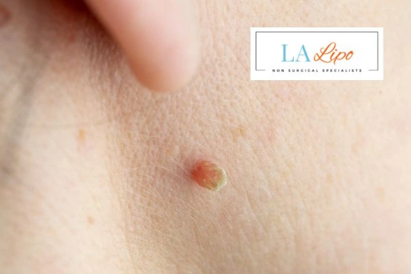Book skin tag removal Greater London (Lambeth) today speak to our team now!