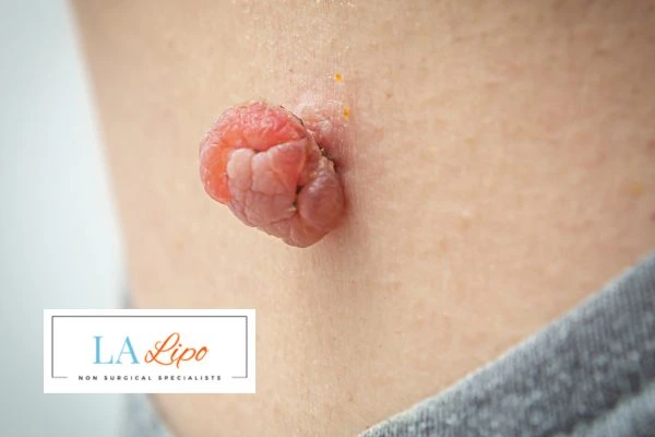 Interested in skin tag removal Greater London (Lambeth)? Concerned about the pain? Find out more today!