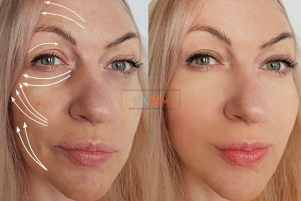 Morpheus 8 results Greater London (Lambeth) face lift.