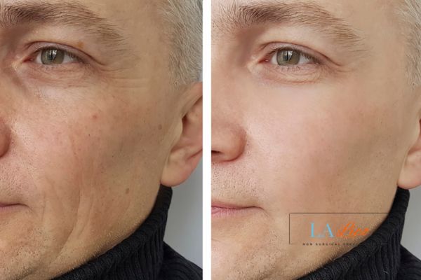See the amazing results of Morpheus8 Treatment Greater London (Lambeth)!