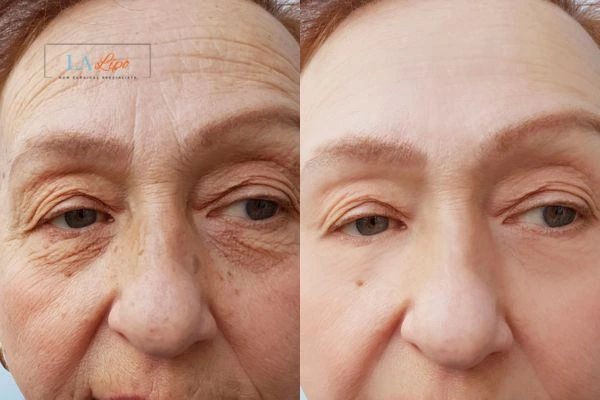 The powerful benefits of Morpheus8 Treatment Greater London (Lambeth) - Call Our team today!