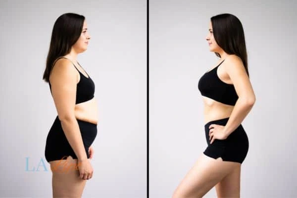 Picture of womans before and after using LA-EMS body sculpting to improve her core strength Greater London (Lambeth)