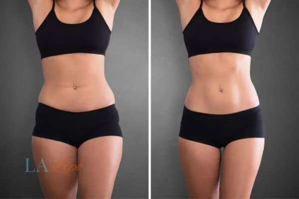 before and after results of non-surgical treatment to help a woman's body image and mental health Greater London (Lambeth)