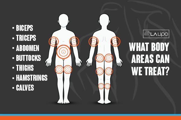 Diagram to show areas you can have LA-EMS Body Sculpting Treatment Greater London (Lambeth)