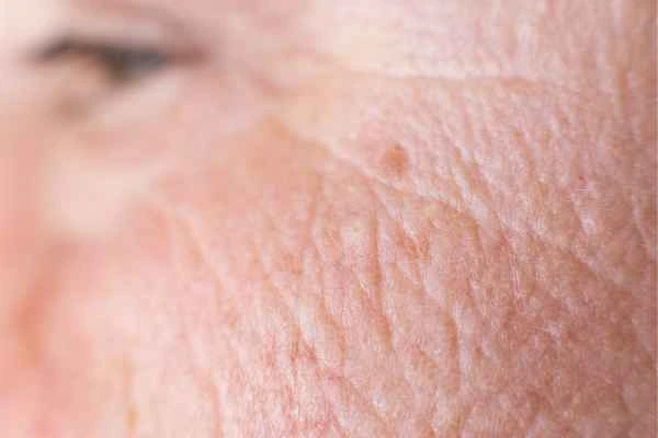 close up picture of a woman's face showing an age spot Greater London (Lambeth)