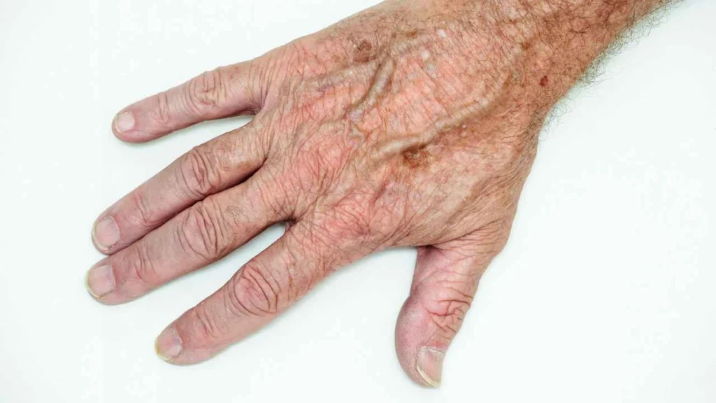 Male hand showing age spot Greater London (Lambeth)