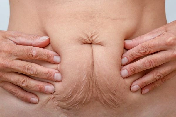Should I Combine Diastasis Recti Treatment with Body Contouring for Better Results Greater London (Lambeth)?